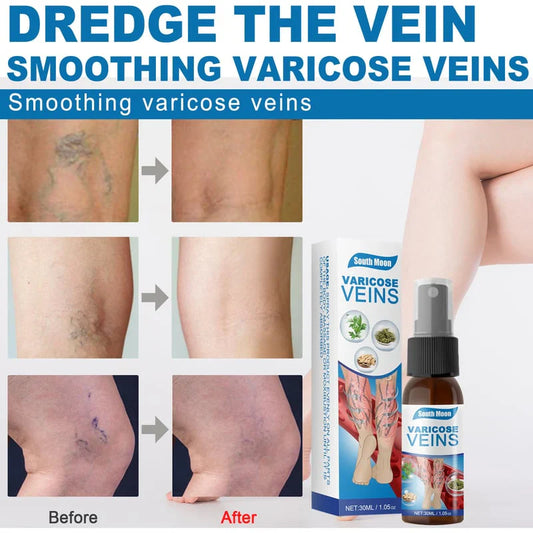 Varicose Veins Spray TK