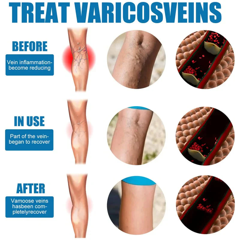 Varicose Veins Spray TK